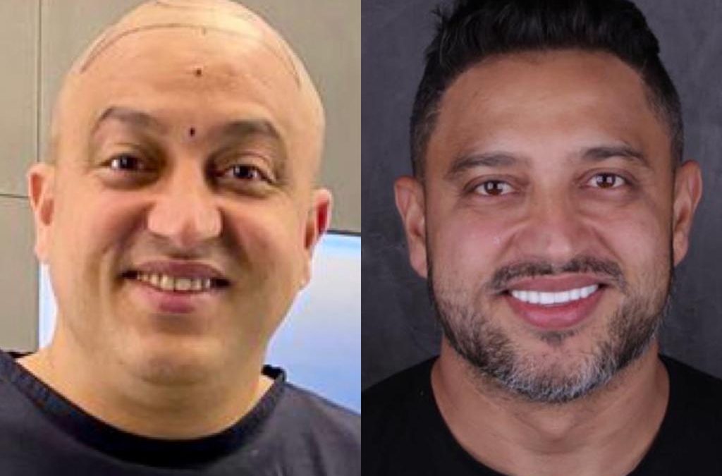 Foto de antes e depois de um procedimento de transplante capilar FUE