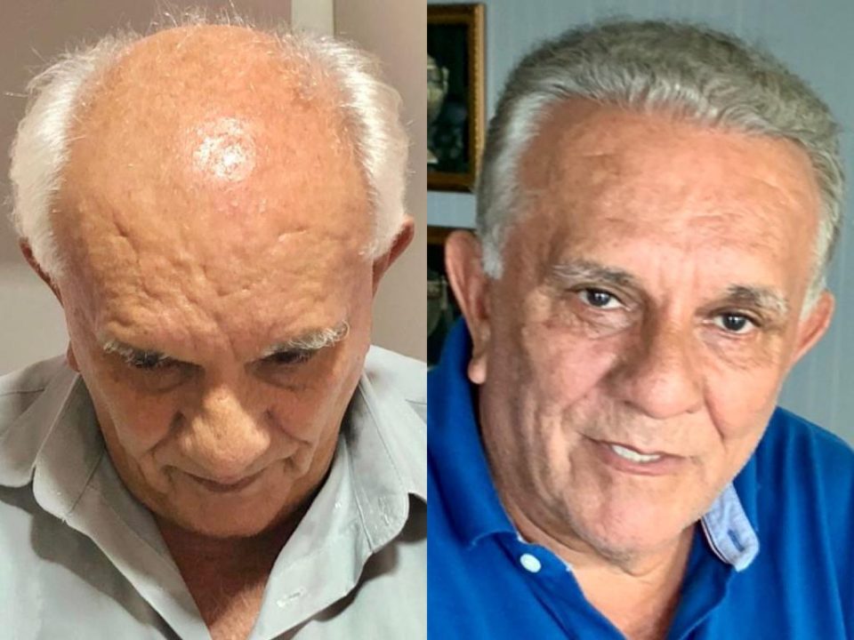 Antes e depois de transplante capilar