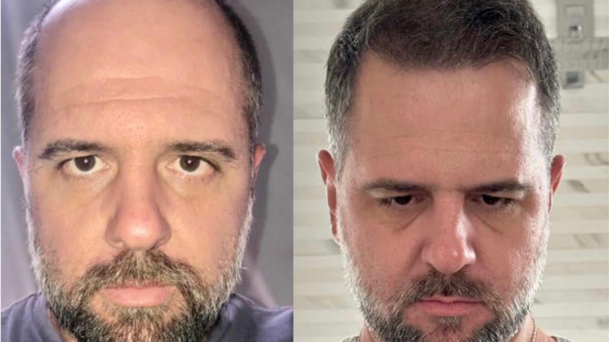 Antes e depois de homem com transplante de cabelo