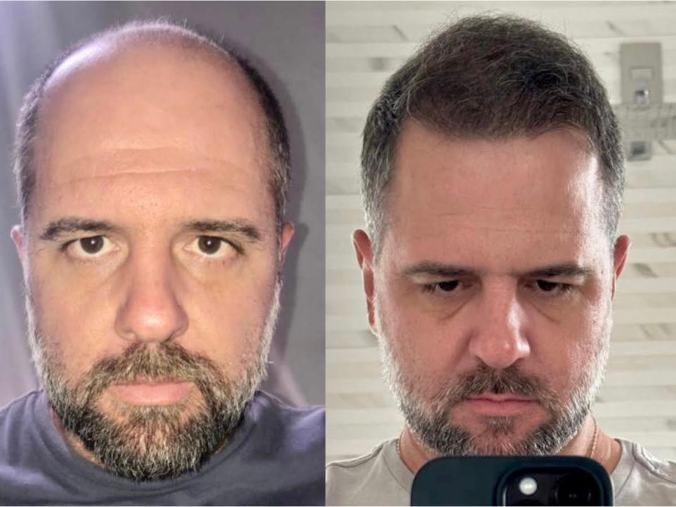 Antes e depois de homem com transplante de cabelo