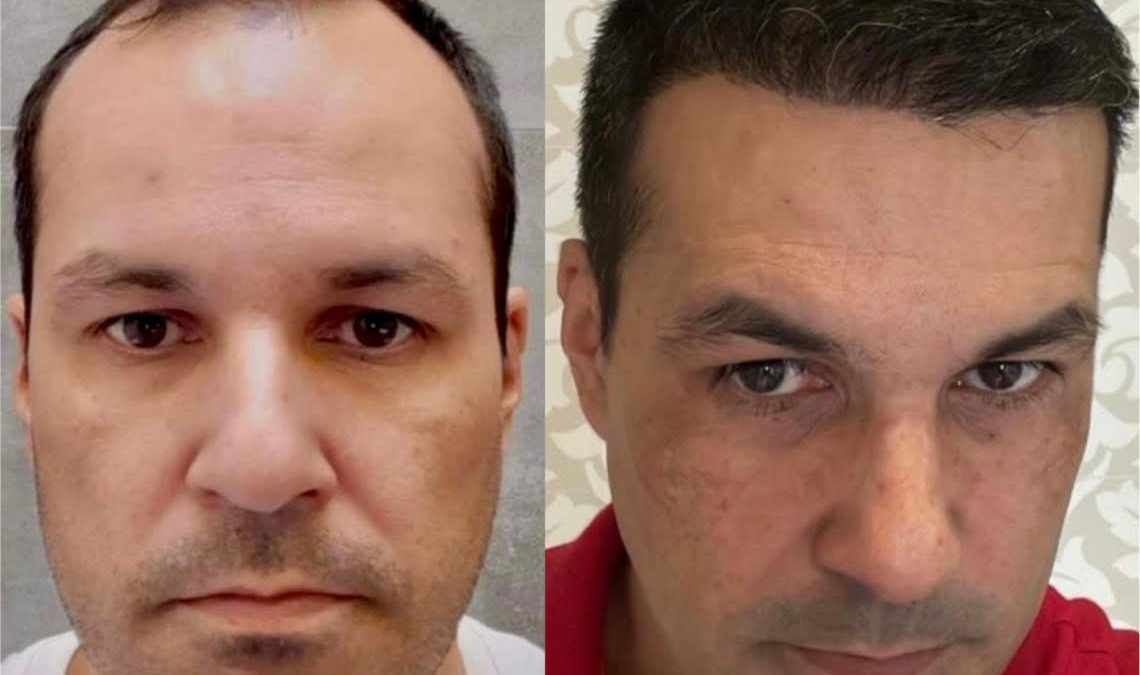 foto de antes e depois de transplante capilar no Grupo Capilar Brasil