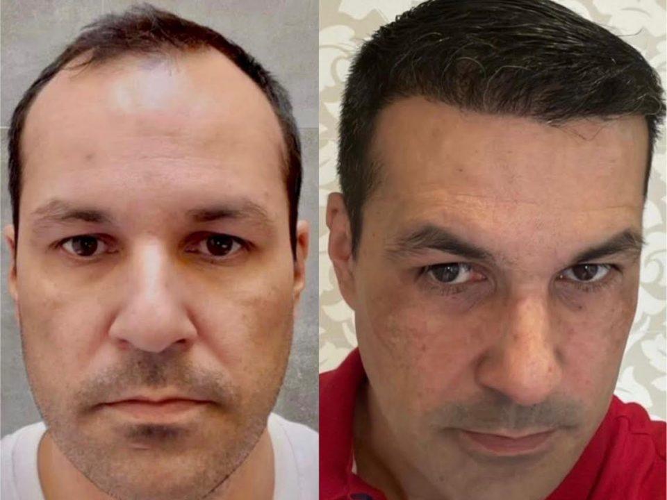 foto de antes e depois de transplante capilar no Grupo Capilar Brasil