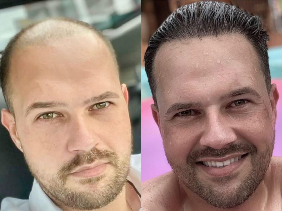 antes e depois transplante capilar - Grupo Capilar